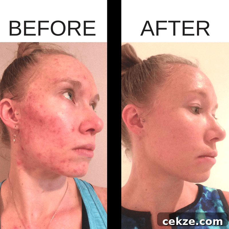 Why I Joined Beautycounter as a Doctor: My Experience and Reasons 5 Before and after acne photos after using Beautycounter products.